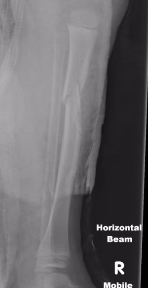 tibia