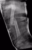 femur