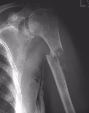 Path # humerus