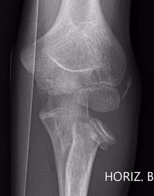 Radial neck