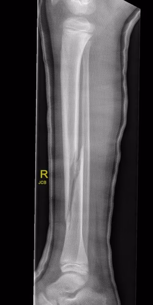 tibia