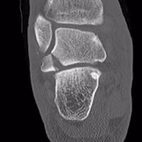 Lateral process talus