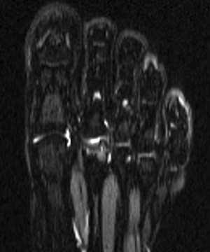 Focal chondral defect