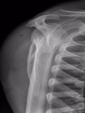 scapula