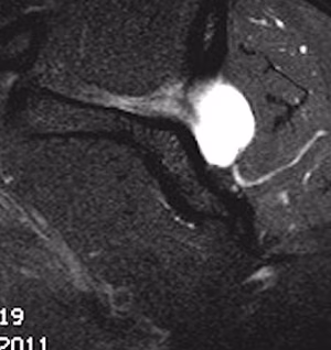 labral cyst