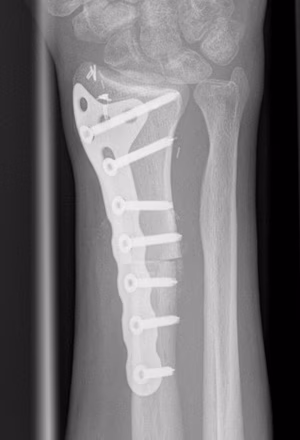 DR GCT allograft