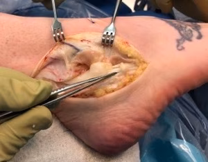 Peroneal