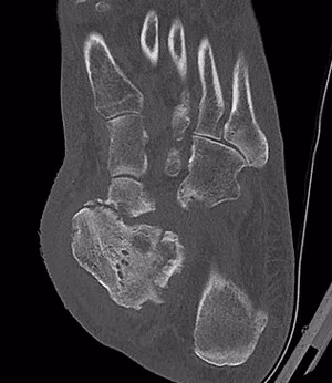 Charcot