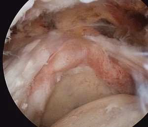 Massive cuff tear