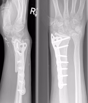DR GCT allograft wrist subluxation