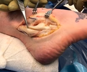 Peroneal