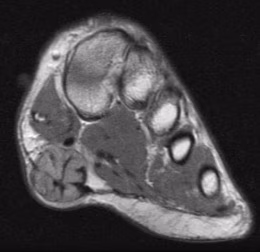 fibroma