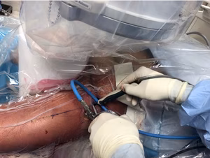 LT psoas rel 4