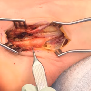 Schwannoma