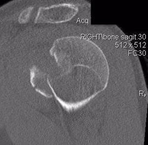 LT fracture