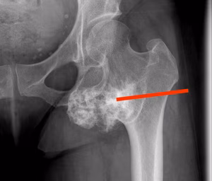 Proximal femur biopsy