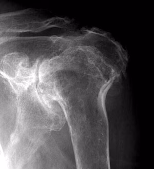 Destructive rheumatoid shoulder 2