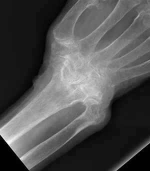 RA wrist