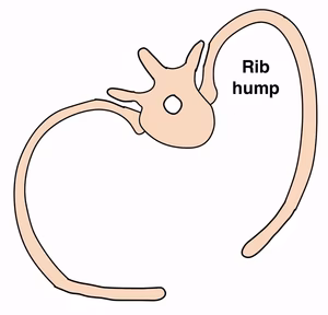 rib hump