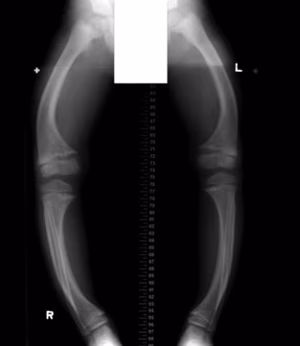 Rickets