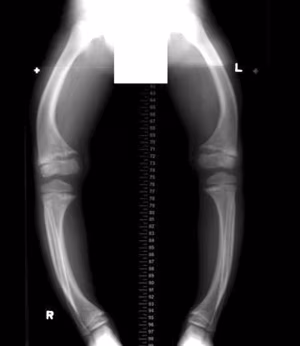 Rickets