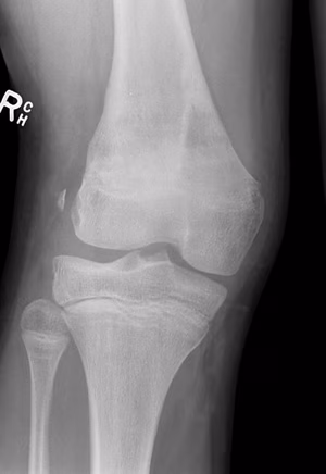 Distal femur