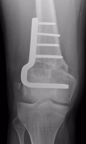dis femur