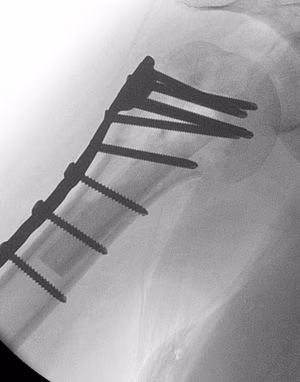 fibular strut