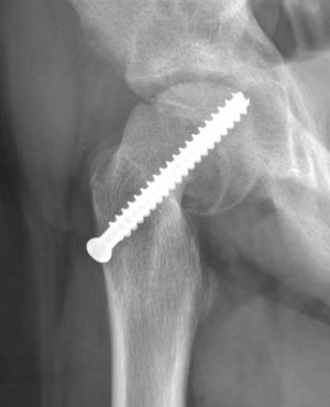 intra articular