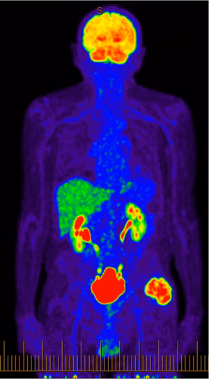 Sarcoma PET