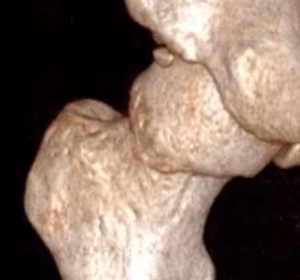 Os acetabuli