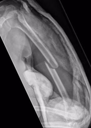 Humerus shaft