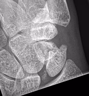 scaphoid