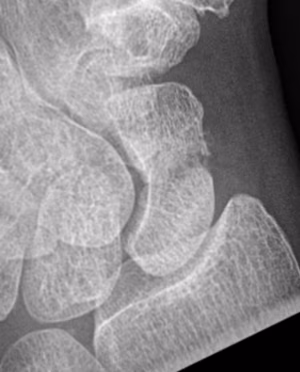 scaphoid
