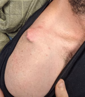 Skin threaten distal clavicle