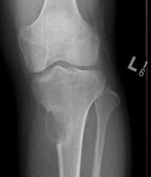 chondromyxoid fibroma 1