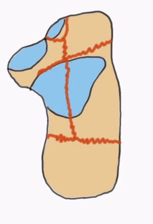 Calc fracture