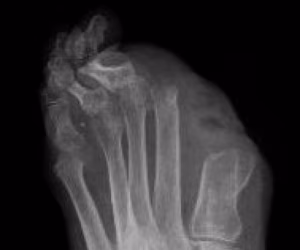 Toe amputation