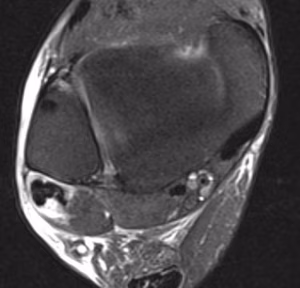 P longus split