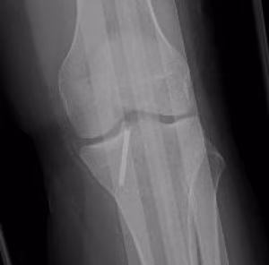 acl avulsion