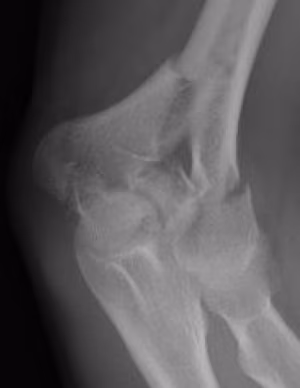 Distal 1/3