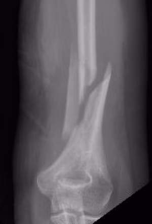 Distal 1/3