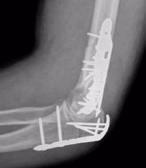 distal humerus