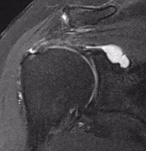 cyst