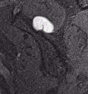 cyst