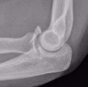 coronoid
