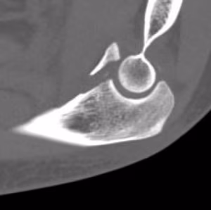 coronoid