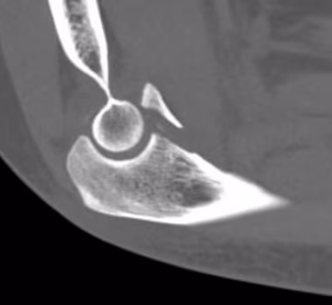coronoid p