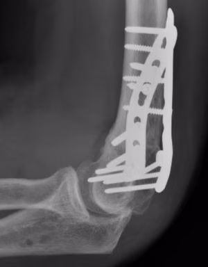 triplane osteotomy