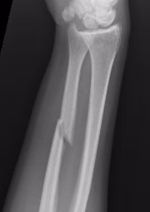ulna